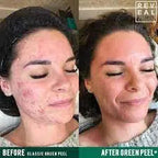 The Original GREEN PEEL® Herbal Peeling