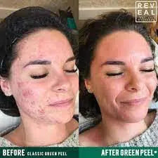 The Original GREEN PEEL® herbal peeling