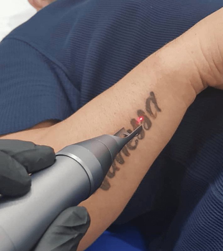 Free tattoo removal for former gang members