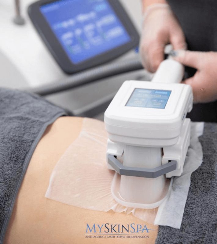 3D Lipo Cryolipolysis (Fat Freezing) My Skin Spa