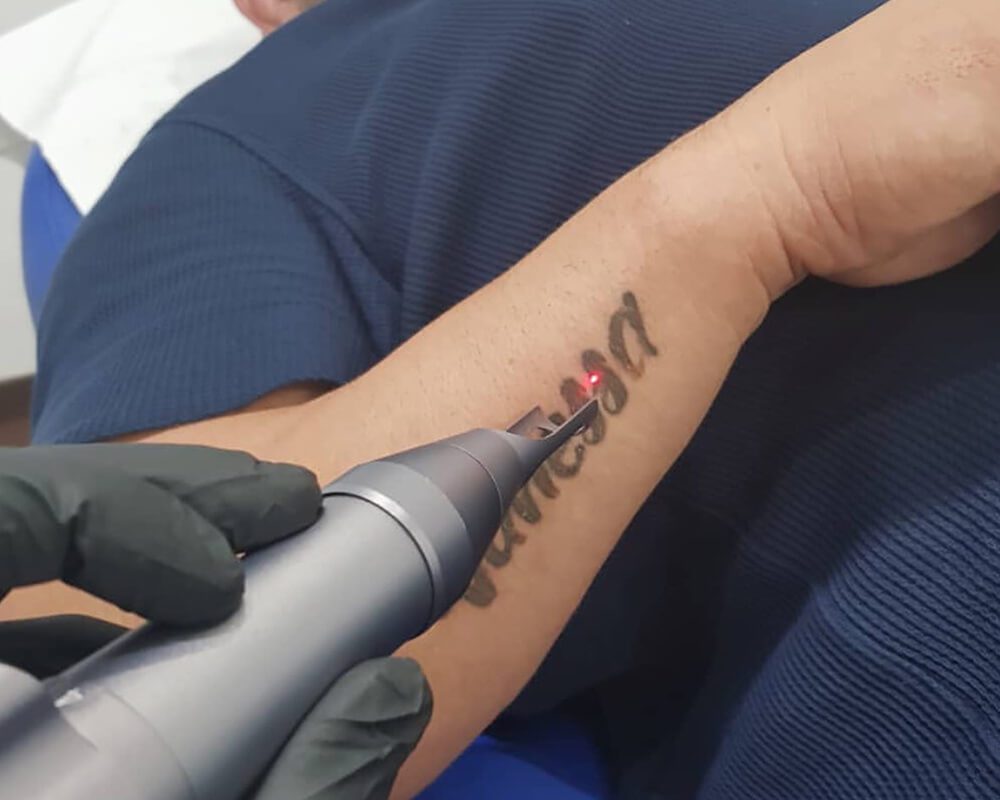 Laser Tattoo Removal My Skin Spa Laser Tattoo Removal My Skin Spa