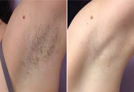 Laser Hair Removal (Diode) Medical Grade My Skin Spa Laser Hair Removal (Diode) Medical Grade My Skin Spa