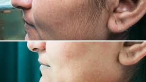 Laser Hair Removal (Diode) Medical Grade My Skin Spa Laser Hair Removal (Diode) Medical Grade My Skin Spa