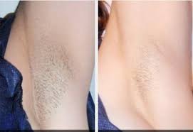 Laser Hair Removal (Diode) Medical Grade My Skin Spa Laser Hair Removal (Diode) Medical Grade My Skin Spa