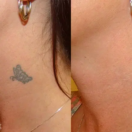Laser Tattoo Removal My Skin Spa Laser Tattoo Removal My Skin Spa